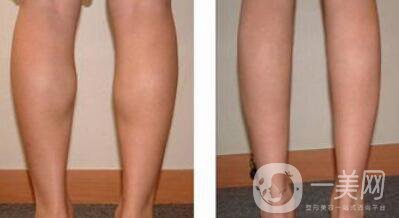 注射*瘦腿*嗎 打**怎么樣