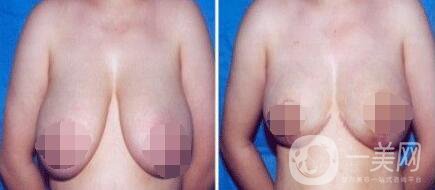 如何縮胸 胸部過大要怎么縮小