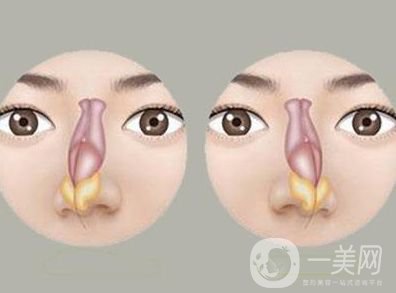 歪鼻子矯正手術(shù)多少錢 價(jià)格詳情