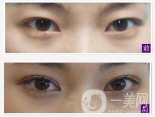 不開刀的雙眼皮方式有哪幾種？