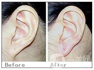 注射玻尿酸豐耳垂好嗎 玻尿酸填充耳垂怎么樣