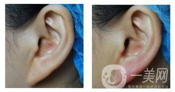 注射玻尿酸豐耳垂好嗎 玻尿酸填充耳垂怎么樣
