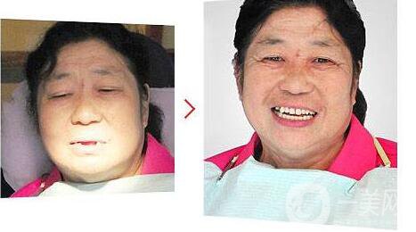 種植牙,優(yōu)點(diǎn),缺點(diǎn)