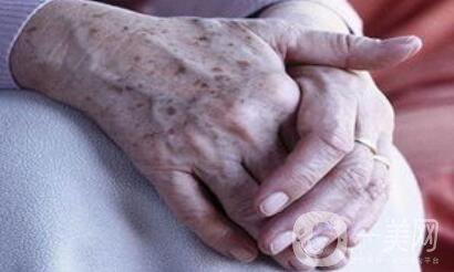 老年斑的形成 身上長老年斑是什么原因