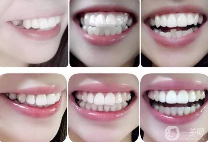 t4a可以矯正牙齒嗎 t4a牙齒矯正器怎么樣