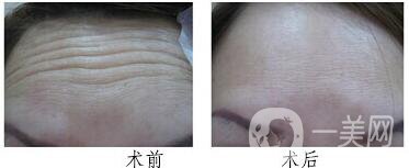 抬頭紋太深怎么去掉 去抬頭紋*果照片