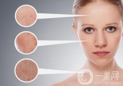 激光祛斑會反彈嗎 要注意些什么