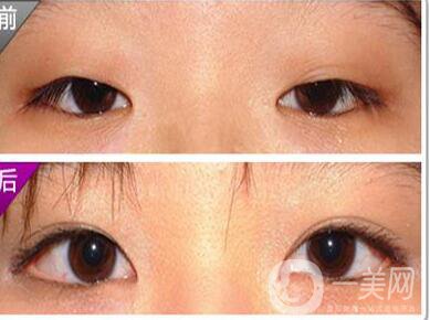 開(kāi)內(nèi)外眼角,*果