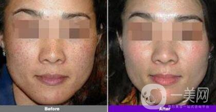 *風(fēng)范祛斑做幾次*果 祛斑*果圖