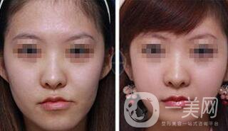 打玻尿酸后注意什么 注射玻尿酸如何護(hù)理