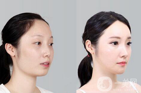 磨腮削骨多少錢？腮幫子磨骨多少錢？