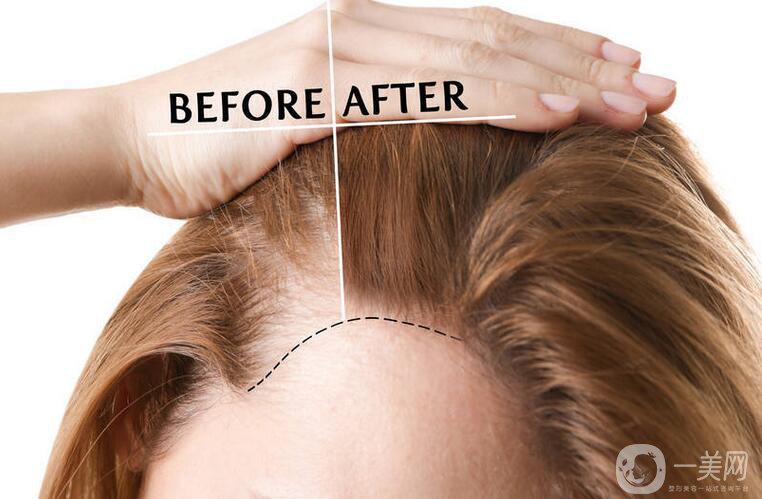 鄭州,頭發(fā)移植,醫(yī)院