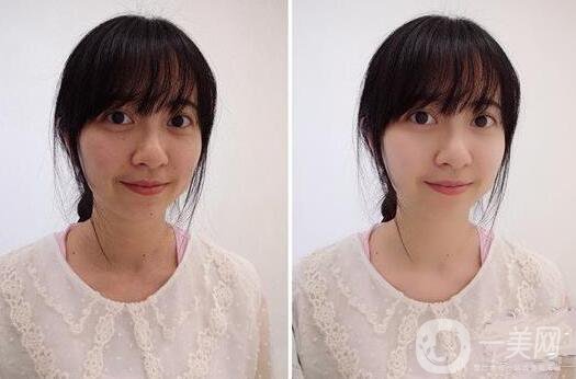 北京,彩光嫩膚,好不好