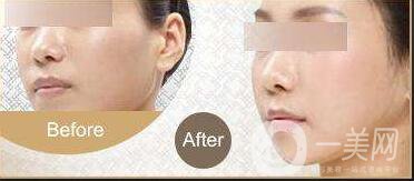 彩光嫩膚祛斑,多少錢