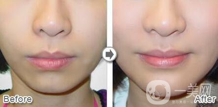 伊維蘭豐下巴*果 伊維蘭墊下巴怎么樣