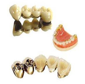 北京貴金屬烤瓷牙多少錢 貴金屬烤瓷牙價(jià)格詳解