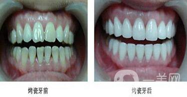 北京貴金屬烤瓷牙多少錢 貴金屬烤瓷牙價(jià)格詳解