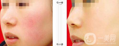 彩光祛紅血絲多少錢(qián) 彩光祛紅血絲價(jià)格介紹