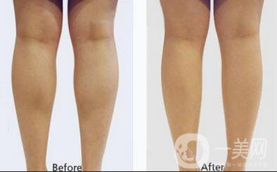 打*一般需要多少錢