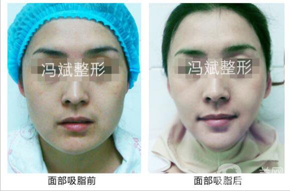 北京東方和諧馮斌整形價(jià)格表2018國(guó)慶特惠出爐