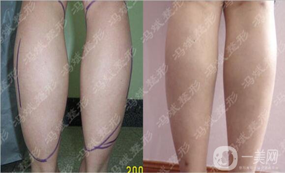 北京東方和諧馮斌整形價(jià)格表2018國(guó)慶特惠出爐