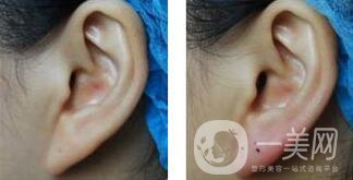 玻尿酸豐耳垂怎么樣 豐耳垂前后圖