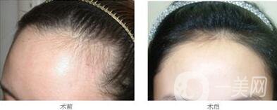 北京植發(fā)醫(yī)院信息介紹？哪里植發(fā)好？