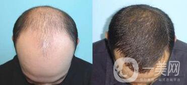 北京植發(fā)醫(yī)院信息介紹？哪里植發(fā)好？