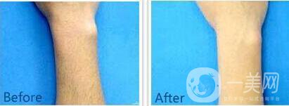 手臂激光脫毛,多少錢