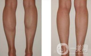 在上海*瘦小腿需要多少錢