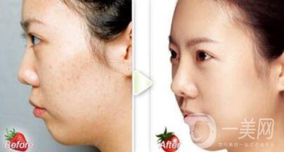 正規(guī)醫(yī)院做果酸換膚要多少錢？