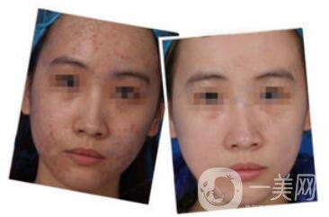 正規(guī)醫(yī)院做果酸換膚要多少錢？