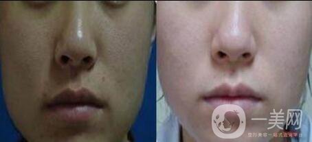 做一次黑臉娃娃需要多少錢