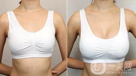 做豐胸手術(shù)時會痛嗎 術(shù)后恢復(fù)痛嗎