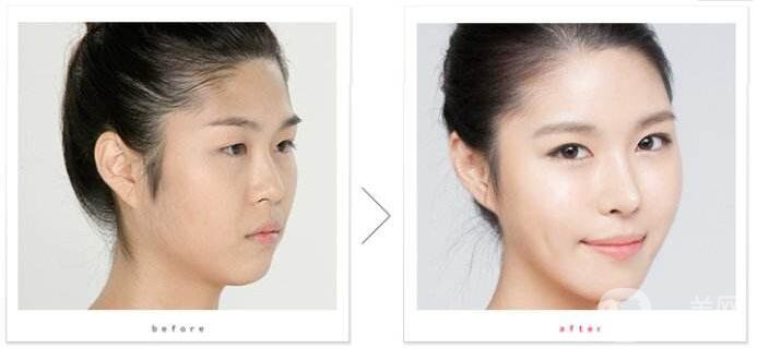 在武漢做專業(yè)隆鼻修復(fù)多少錢