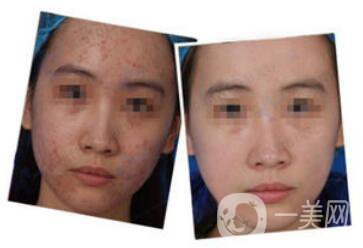 杭州做個果酸換膚大概多少錢