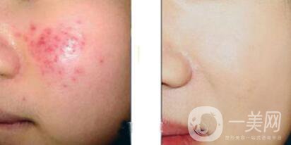 果酸換膚的副作用？果酸換膚幾天恢復(fù)？