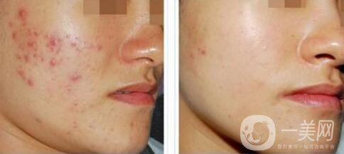 果酸換膚的副作用？果酸換膚幾天恢復(fù)？