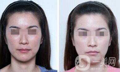 北京正規(guī)醫(yī)院嫩膚具體多少錢