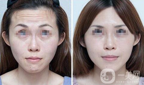 成都*除皺價格大概多少