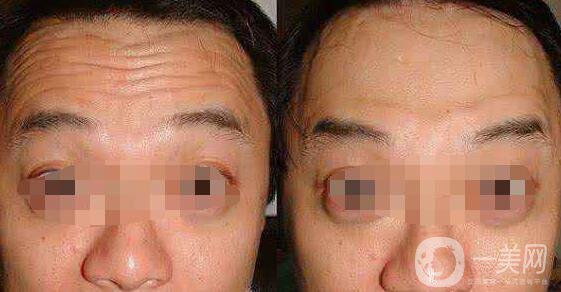 成都*除皺價格大概多少