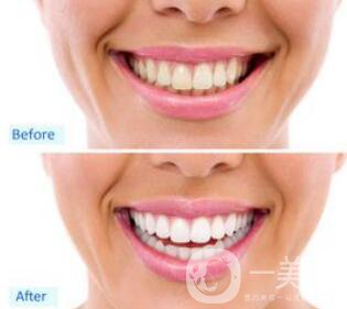 洗牙后具體注意事項(xiàng)有哪些