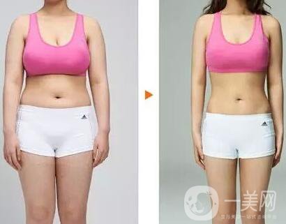 鐳射溶脂價(jià)格要多少錢(qián)？