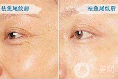 *,注射去皺,多少錢