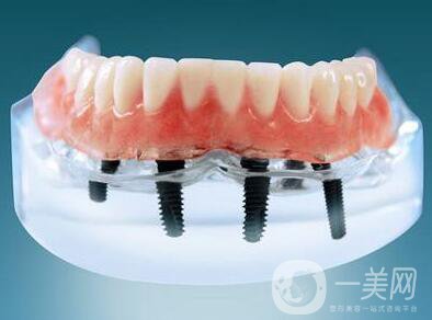 種植牙可以用多久？維持時(shí)間