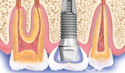 種植牙可以用多久？維持時(shí)間