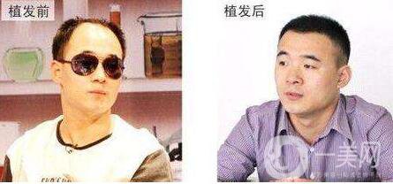 fut植發(fā)技術(shù),優(yōu)缺點(diǎn)