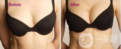 法國es假體隆胸,價格