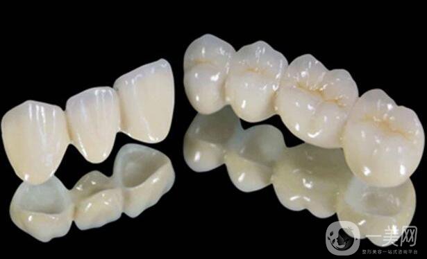 鈷鉻烤瓷牙好不好？可以保持多久？