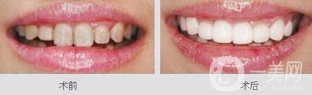 鈷鉻烤瓷牙好不好？可以保持多久？